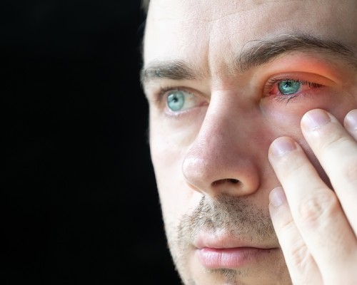 Ochi rosu: 8 cauze si metode de tratament